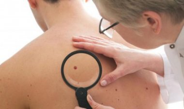 طبيبة أمراض جلدية روسية تكشف عن أخطار الشامات على الجلد