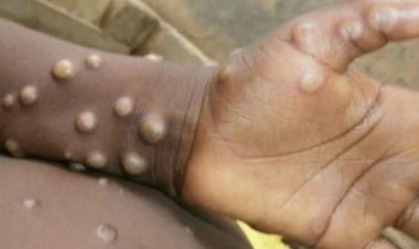 منظمة الصحة العالمية: جدري القردة ليس وباء جديدا مثل كوفيد