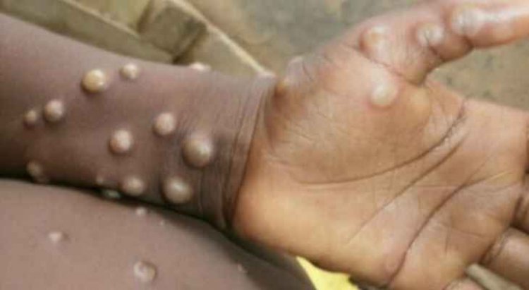 منظمة الصحة العالمية: جدري القردة ليس وباء جديدا مثل كوفيد