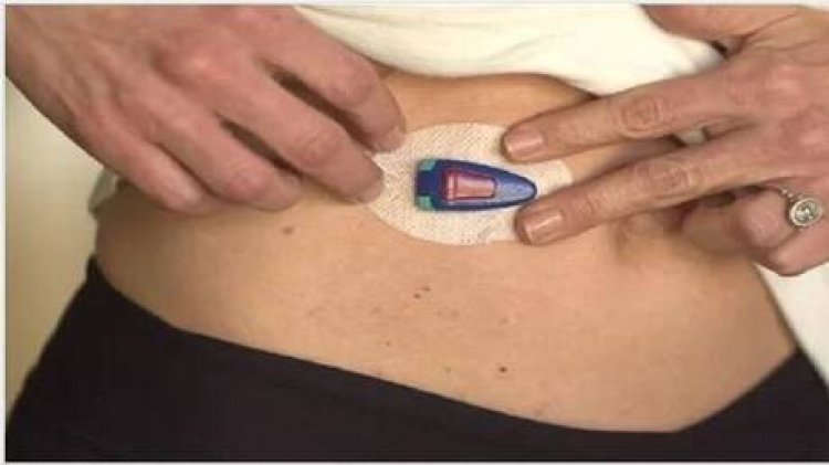 ابتكار روسي لقياس سكر الدم دون الحاجة لوخز الإبر